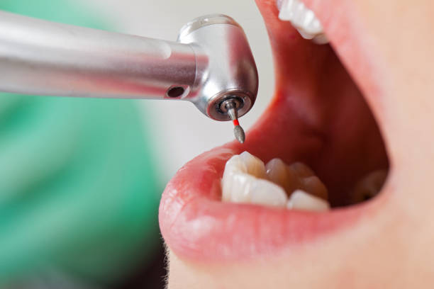 Best Urgent Care for Lost Fillings or Crowns in Robie Creek, ID